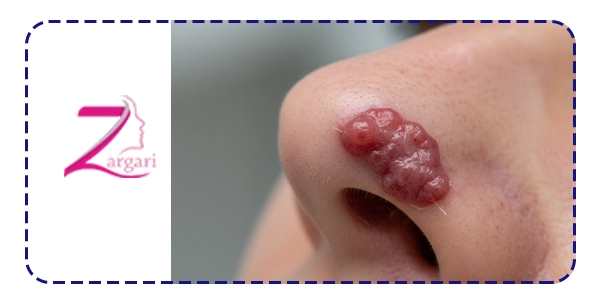 گوشت اضافه بعد از جراحی بینی دقیقا چیست؟