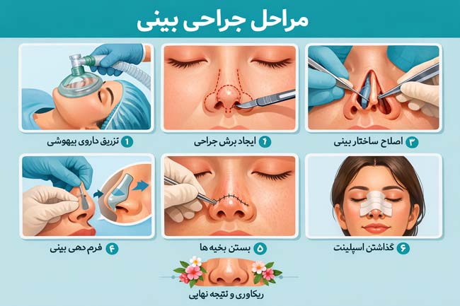 مراحل جراحی بینی