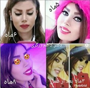 تکنیک های جراحی بینی