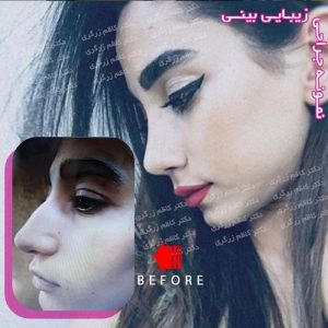 سوالات قبل از عمل بینی